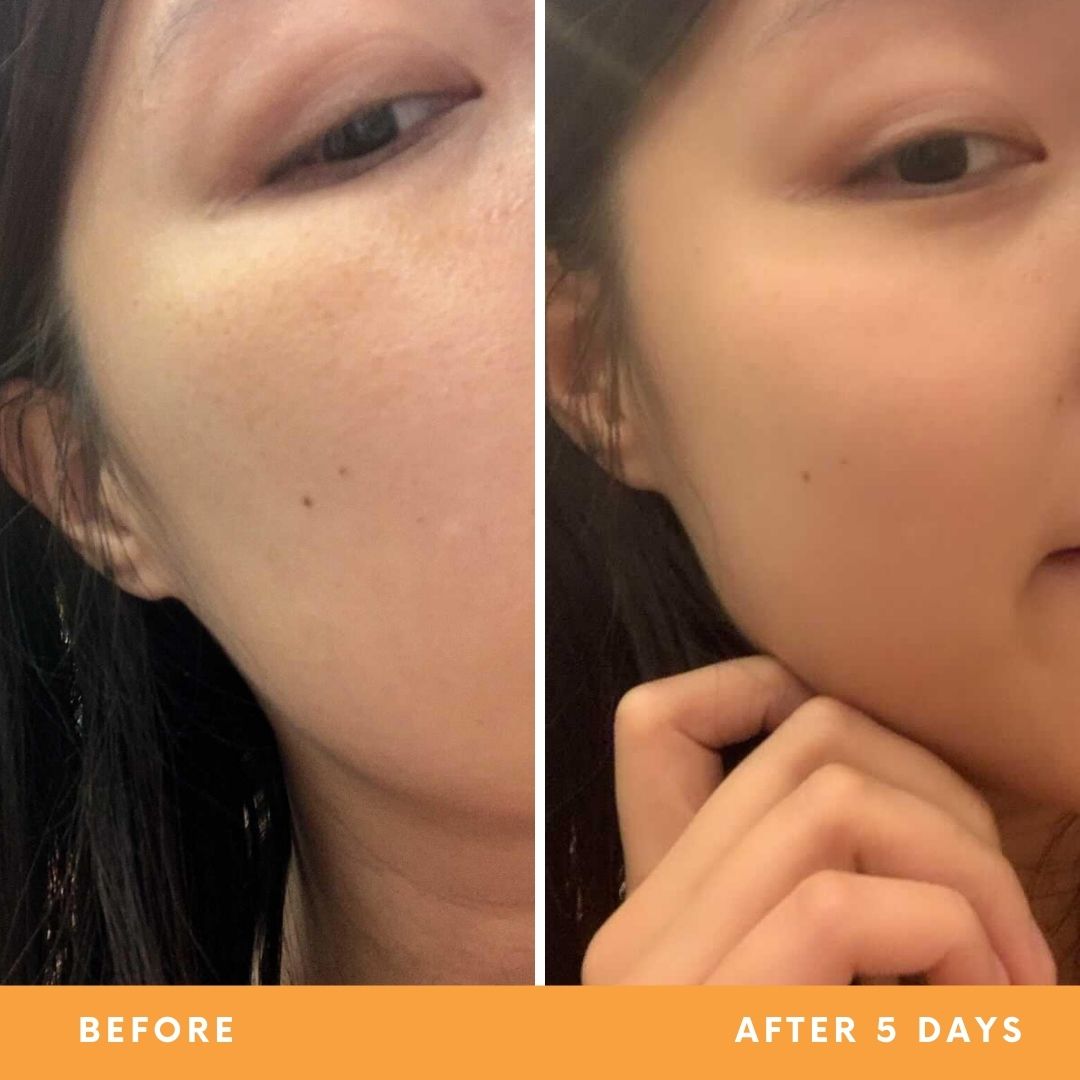 Fiona's oily, combination skin results from using Be Fraiche skincare. Left (before) photo: photo of her face with oily, bumpy complexion, right (after) photo: photo of her face with more balanced, even skin.