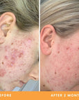 Hollie acne-prone skin results from using Be Fraiche Tea Cleanser. Left (before) photo: acne flared up on her cheek, right (after) photo: acne cleared up, smoother, calmer skin.