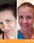 Katie acne-prone skin results from using Be Fraiche Tea Cleanser. Left (before) photo: front photo of her face with uneven skin and acne around her chin, right (after) photo: front photo of her face smiling with smoother, even and calmer skin..