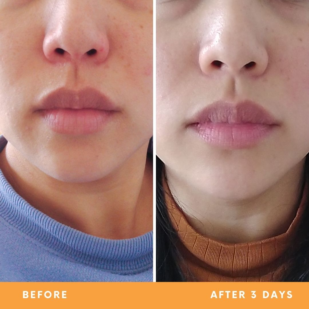 Helen's dry, irritated skin results from using Be Fraiche skincare. Left (before) photo: front photo of her nose & lips with redness and flaky skin, right (after) photo: front photo of her face with smoother, well-moisturised and calmer skin, no redness.