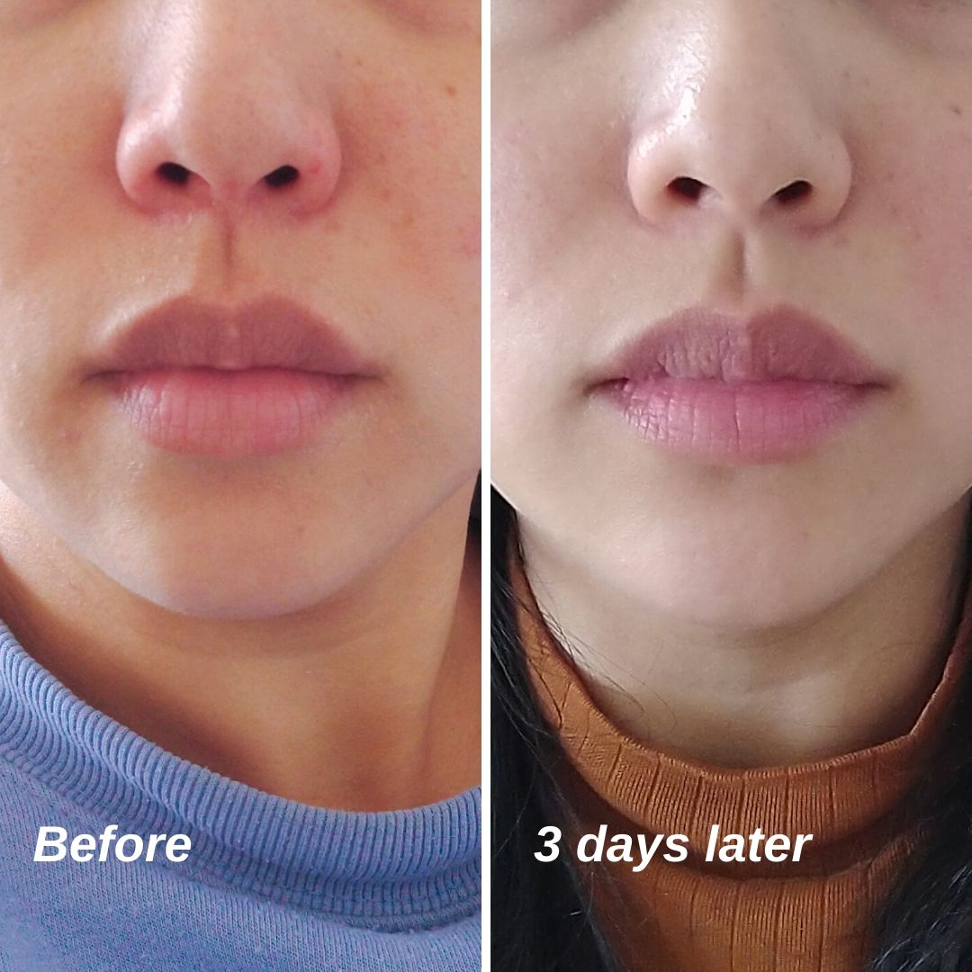 Dry, irritated, flaky skin 3 days results