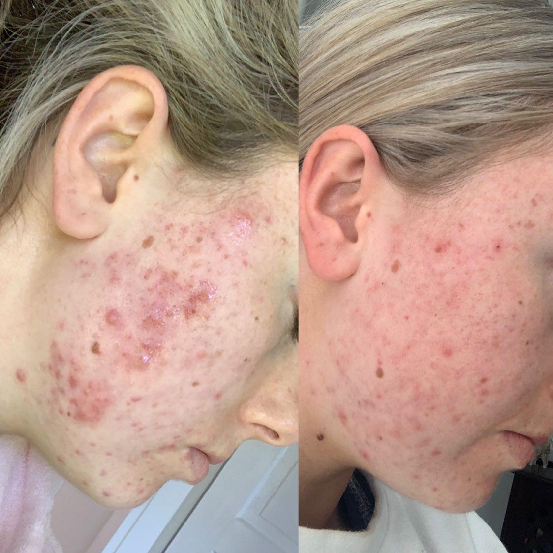 Acne-prone skin 2-month results
