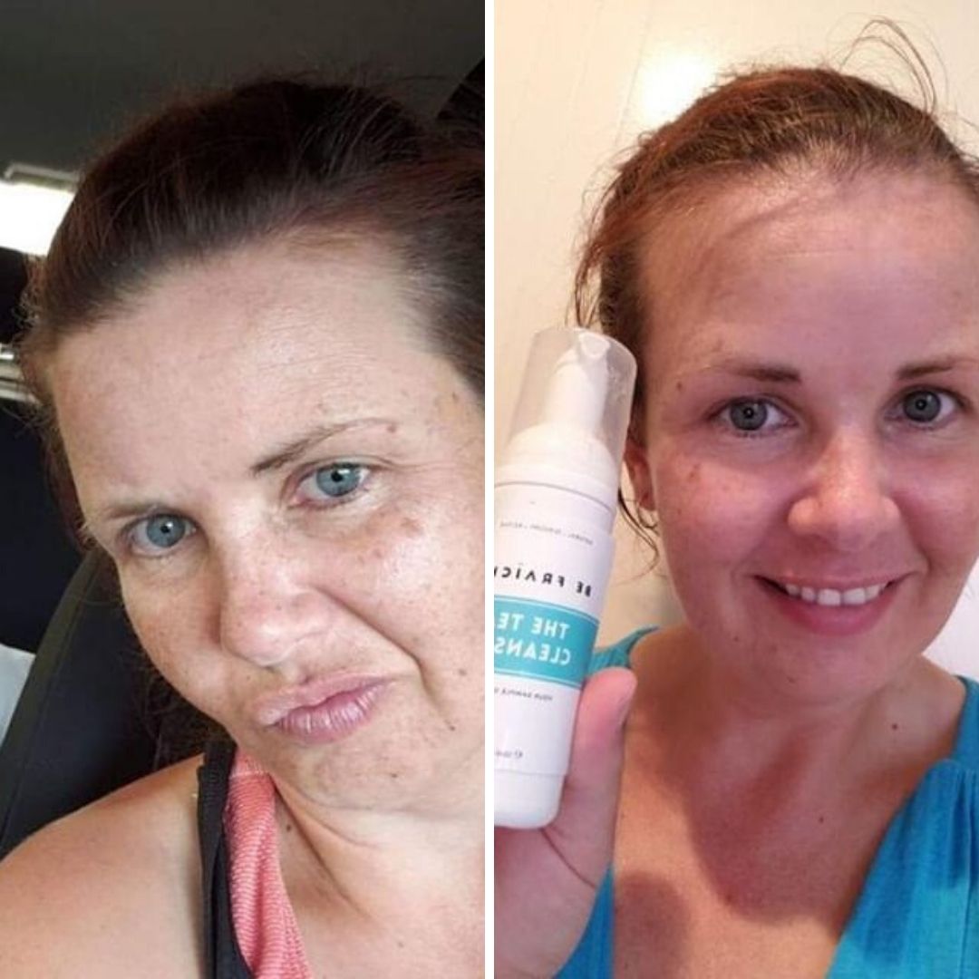 Combination acne-prone skin 1-week results