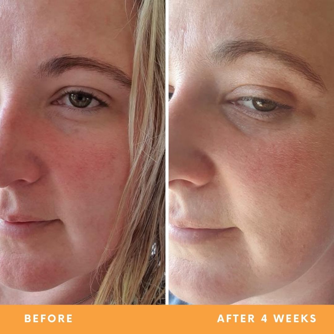 Jess' dry skin and redness results from using Be Fraiche skincare. Left (before) photo: photo of her face with red, dry skin, right (after) photo: photo of her face with smoother, calmer skin, reduced redness after 4 weeks.