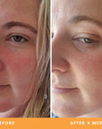 Jess' dry skin and redness results from using Be Fraiche skincare. Left (before) photo: photo of her face with red, dry skin, right (after) photo: photo of her face with smoother, calmer skin, reduced redness after 4 weeks.