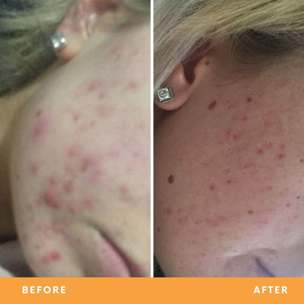 Hollie acne-prone skin results from using Be Fraiche Tea Cleanser. Left (before) photo: acne on her cheek, right (after) photo: acne cleared up, smoother, calmer skin.