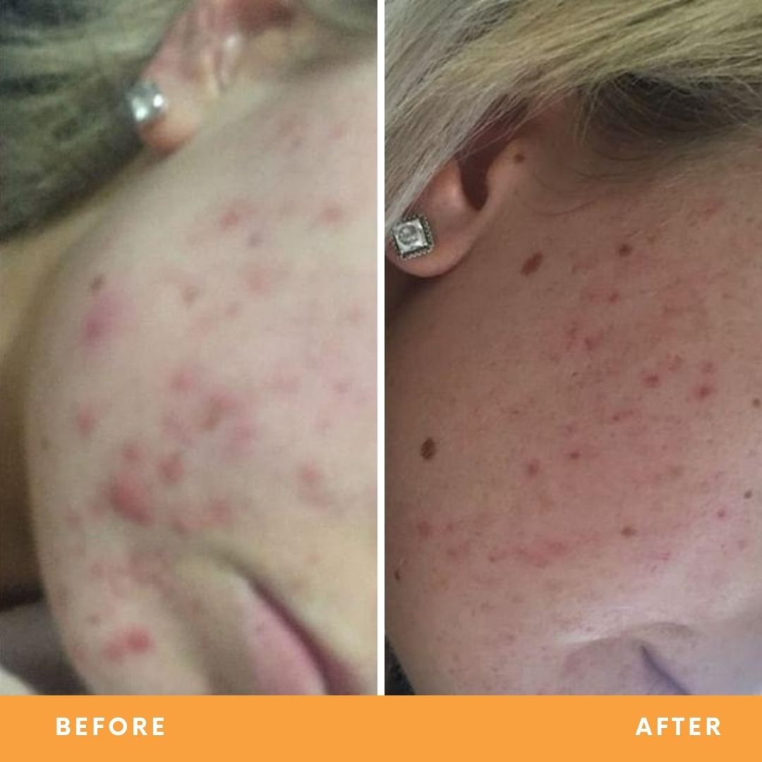 Hollie acne-prone skin results from using Be Fraiche Tea Cleanser. Left (before) photo: acne on her right cheek, right (after) photo: acne cleared up, smoother, calmer skin.