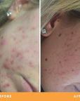 Hollie acne-prone skin results from using Be Fraiche Tea Cleanser. Left (before) photo: acne on her right cheek, right (after) photo: acne cleared up, smoother, calmer skin.