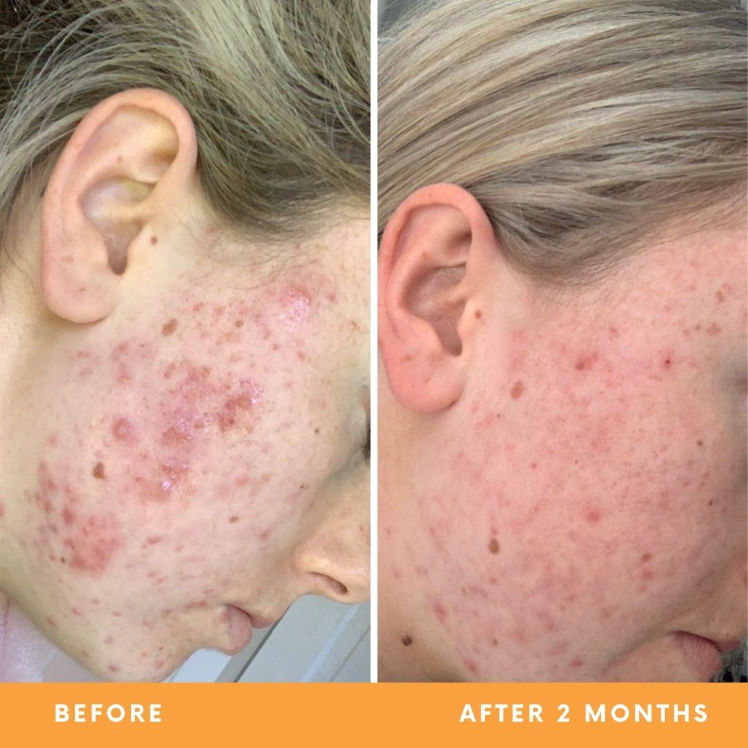 Hollie acne-prone skin results from using Be Fraiche Tea Cleanser. Left (before) photo: acne flared up on her cheek, right (after) photo: acne cleared up, smoother, calmer skin.