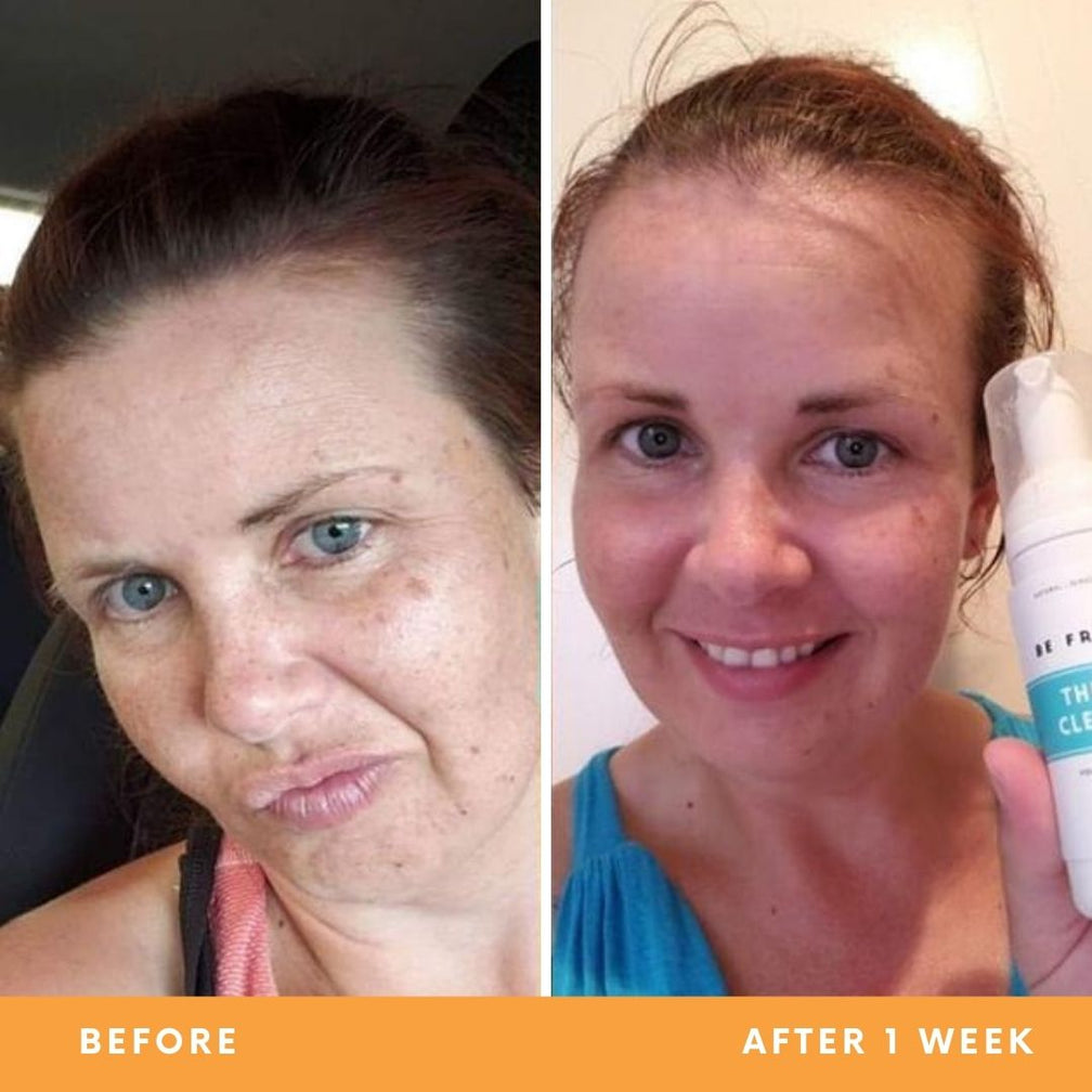 Katie acne-prone skin results from using Be Fraiche Tea Cleanser. Left (before) photo: front photo of her face with uneven skin and acne around her chin, right (after) photo: front photo of her face smiling with smoother, even and calmer skin..