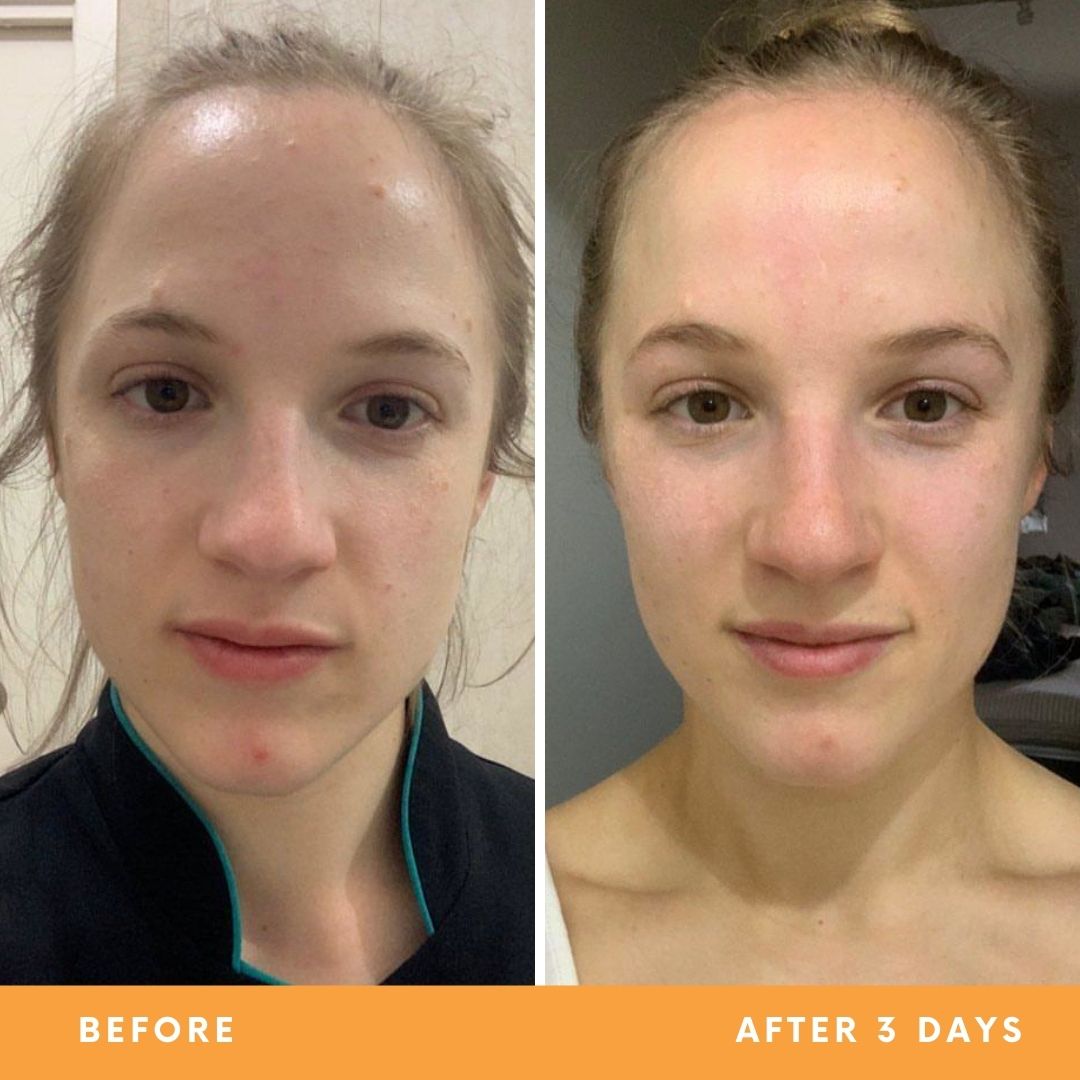 Tessa results from using Be Fraiche skincare. Left (before) photo: front photo of her face with uneven skin and redness and small pimples on her forehead & chin, right (after) photo: front photo of her face smiling with smoother, fresher and calmer skin.