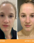 Tessa results from using Be Fraiche skincare. Left (before) photo: front photo of her face with uneven skin and redness and small pimples on her forehead & chin, right (after) photo: front photo of her face smiling with smoother, fresher and calmer skin.