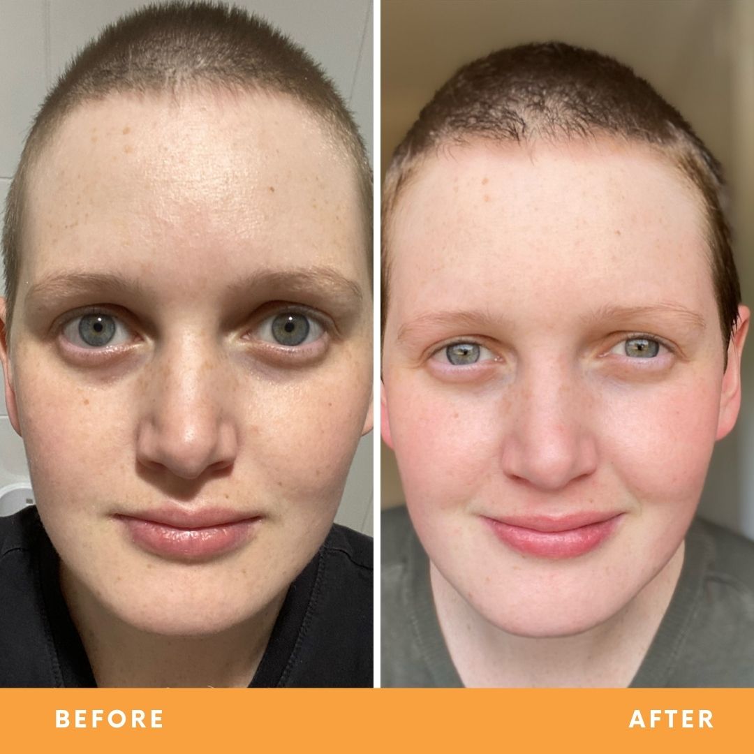 Shannah results from using Be Fraiche skincare. Left (before) photo: front photo of her face with uneven, bumpy skin, right (after) photo: front photo of her face smiling with much smoother, brighter and bouncier complexion.