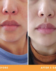 Helen's dry, irritated skin results from using Be Fraiche skincare. Left (before) photo: front photo of her nose & lips with redness and flaky skin, right (after) photo: front photo of her face with smoother, well-moisturised and calmer skin, no redness.