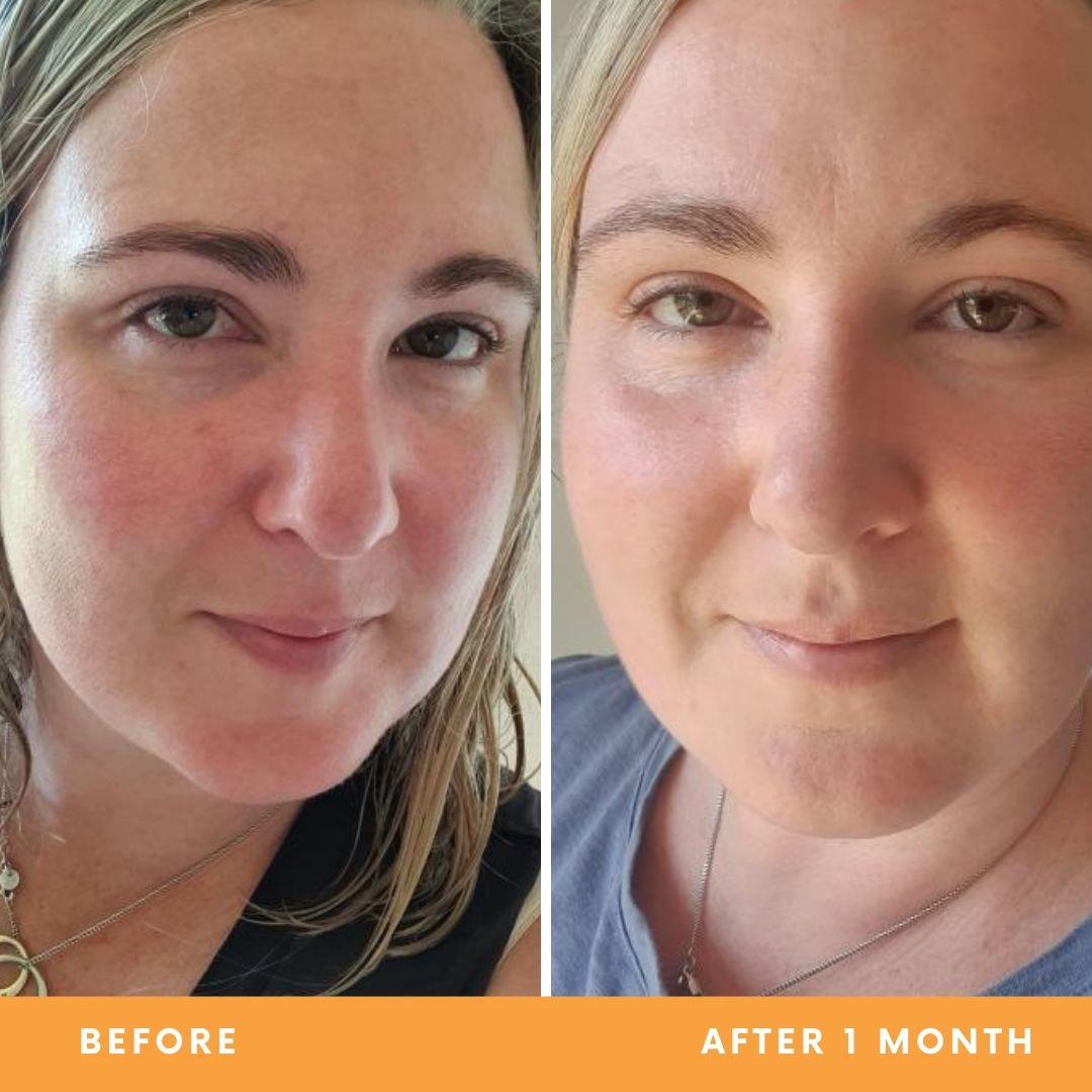 Jess' dry skin and redness results from using Be Fraiche skincare. Left (before) photo: photo of her face with red, dry skin, right (after) photo: photo of her face with smoother, calmer skin, reduced redness.